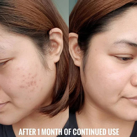 Original Niacinamide Sales 25% OFF🔥 Serum For All Skin, Import Product